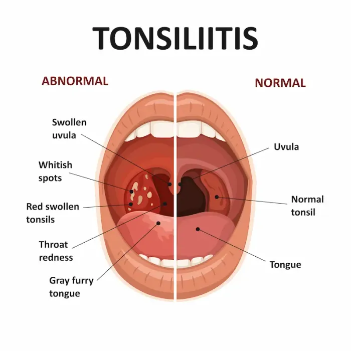 Home Remedies for Tonsillitis A Complete Guide